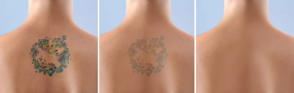 laser tattoo removal services near Harpenden Harmony Laser Lipo Clinic in Dunstable