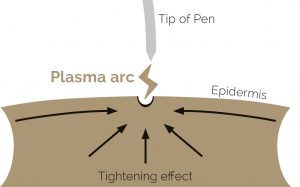 Plasma pen treatment at Harmony Aesthetics Clinic
