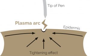 Plasma pen treatment at Harmony Aesthetics Clinic Plasma pen treatment at Harmony Aesthetics Clinic