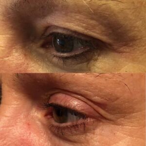 Plasma pen treatment results